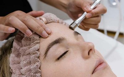 The Top 5 Benefits of Microdermabrasion