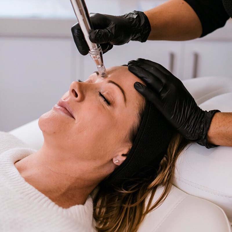 bonny skin studio skin needling